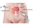 Laparoscopic Surgery