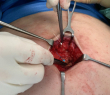 Open Surgery