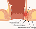 Intersphincteric Fistula