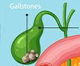What is a Gallbladder Stone?