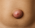 Most Suitable Surgical Technique for Umbilical Hernia Treatment